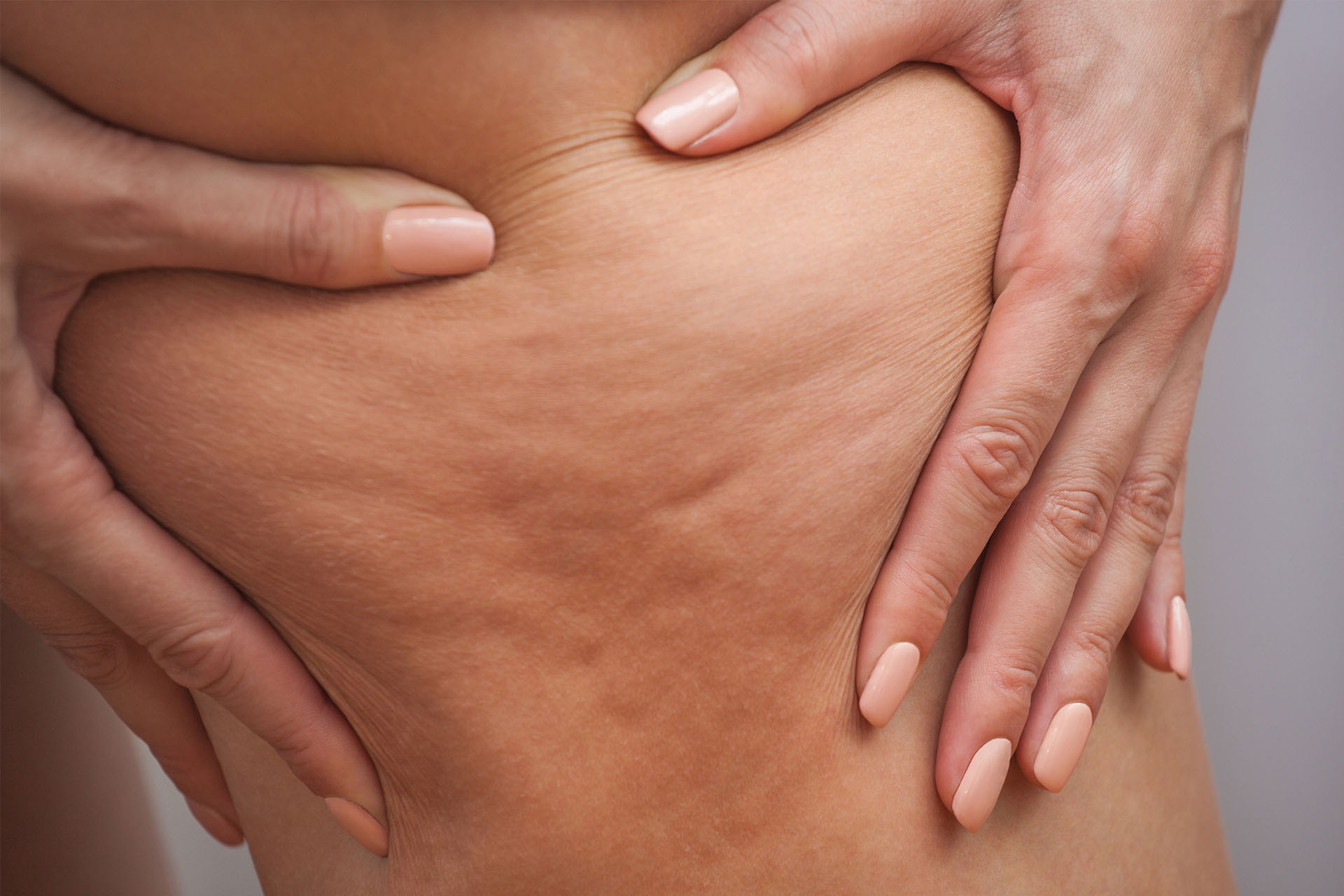 Primo piano di una coscia femminile con pelle compressa tra le mani per mostrare la presenza di cellulite.